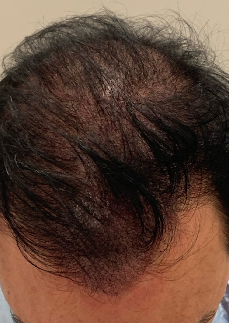 Scalp Micropigmentation Procedures Before & After Gallery - Patient 409522 - Image 2