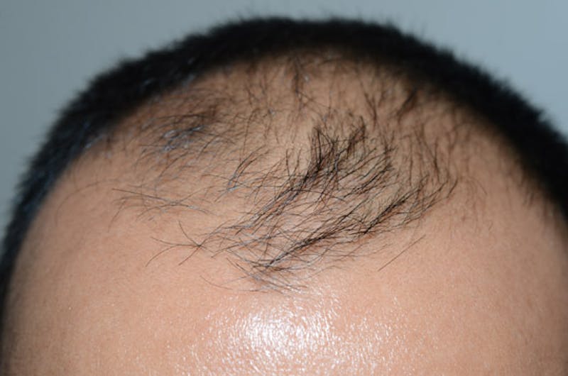 Hair Restoration for Men Before & After Gallery - Patient 223738 - Image 1