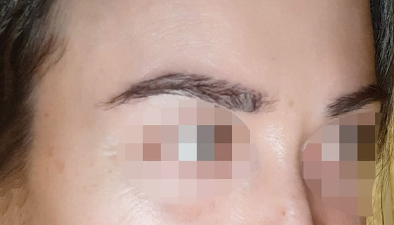 Eyebrow Transplantation Before & After Gallery - Patient 429093 - Image 6