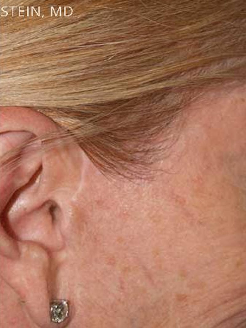 Facial Hair Transplant Before & After Gallery - Patient 344806 - Image 2
