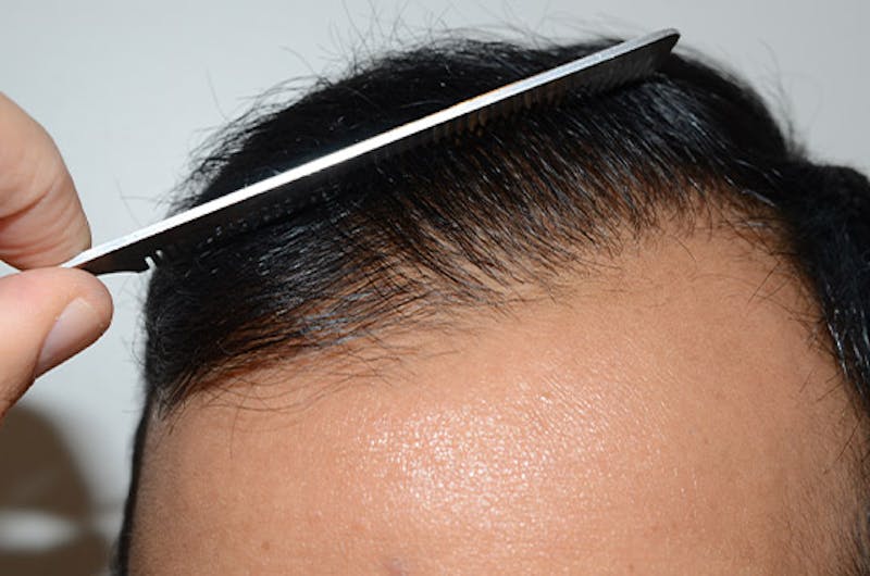 Hair Restoration for Men Before & After Gallery - Patient 223738 - Image 2