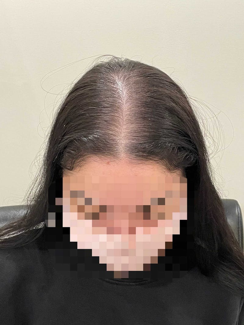 Scalp Micropigmentation Procedures Before & After Gallery - Patient 122288 - Image 1