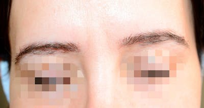 Eyebrow Transplantation Before & After Gallery - Patient 197578 - Image 1