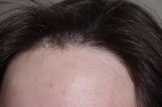 Hair Procedures for Women Before & After Gallery - Patient 327711 - Image 8