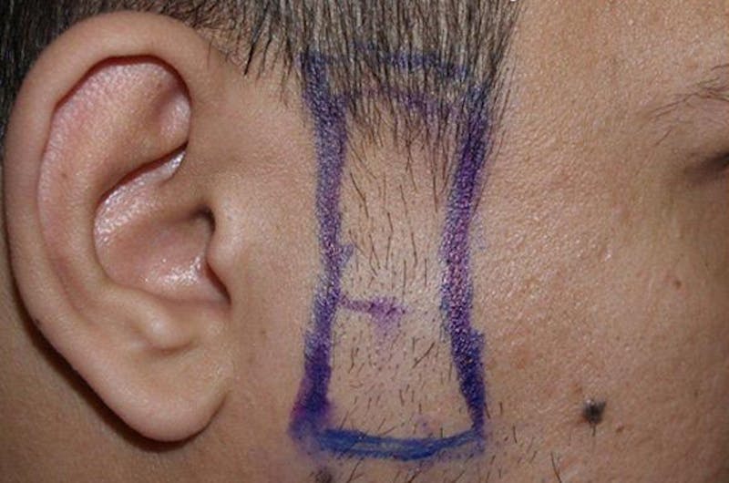 Facial Hair Transplant Before & After Gallery - Patient 160582 - Image 1