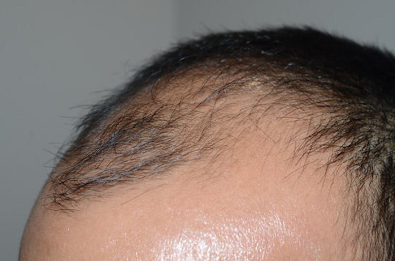 Hair Restoration for Men Before & After Gallery - Patient 223738 - Image 3