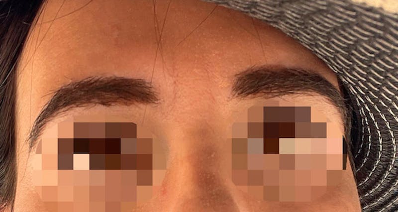 Eyebrow Transplantation Before & After Gallery - Patient 222649 - Image 2