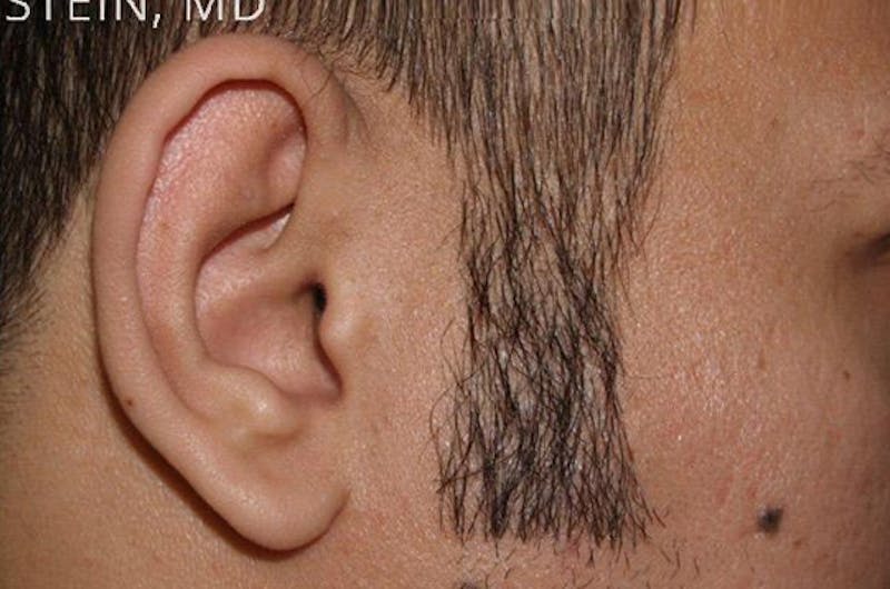 Facial Hair Transplant Before & After Gallery - Patient 160582 - Image 2