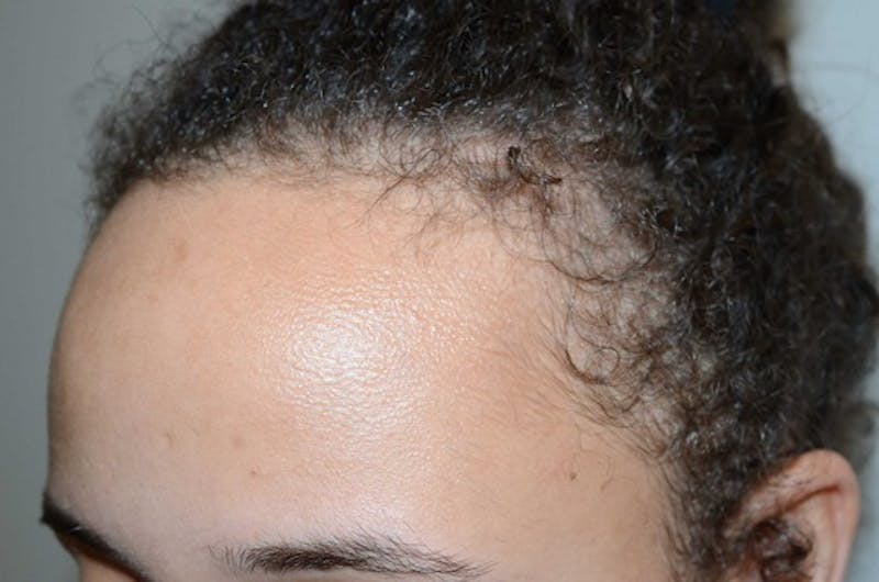 Hairline Lowering Surgery Before & After Gallery - Patient 110099 - Image 3