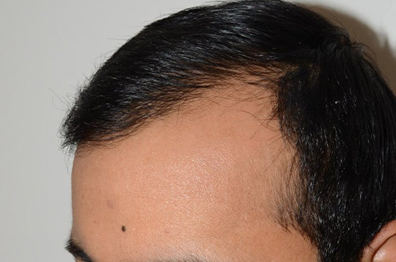 Hair Restoration for Men Before & After Gallery - Patient 223738 - Image 4