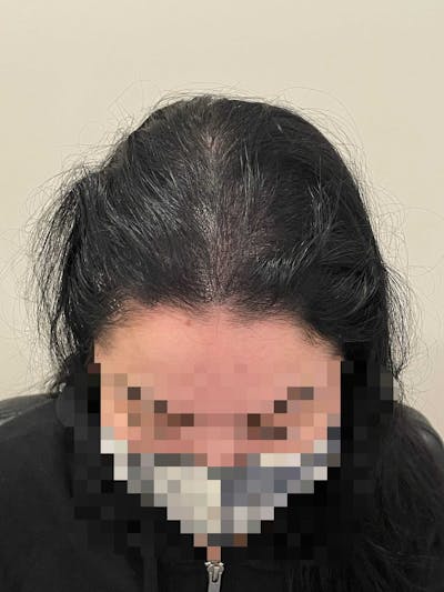 SMP Procedures Before & After Gallery - Patient 298208 - Image 2