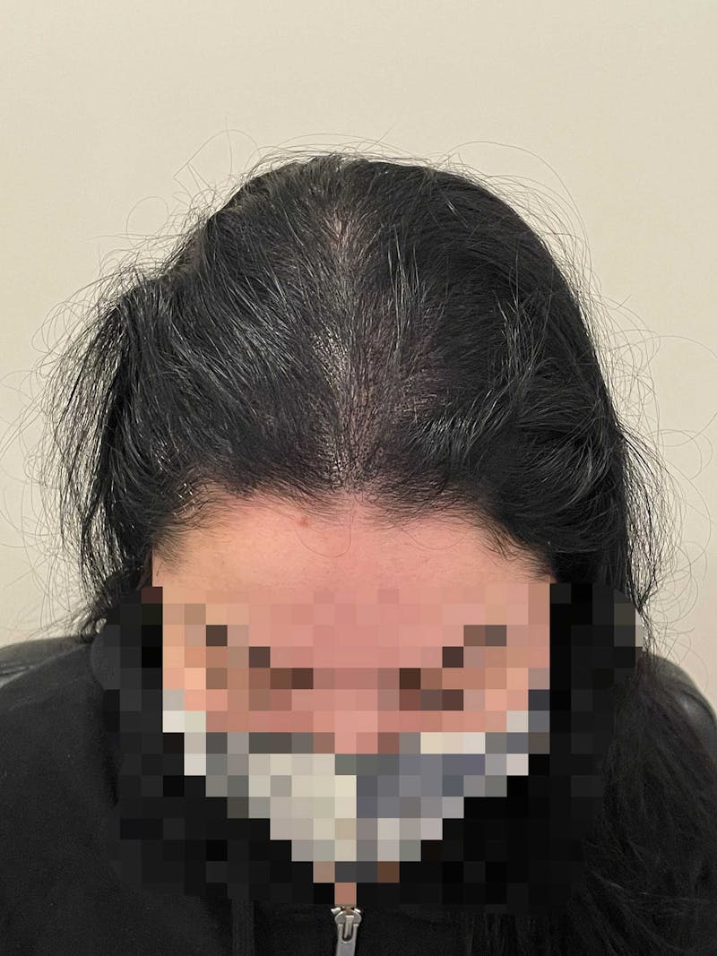Scalp Micropigmentation Procedures Before & After Gallery - Patient 122288 - Image 2