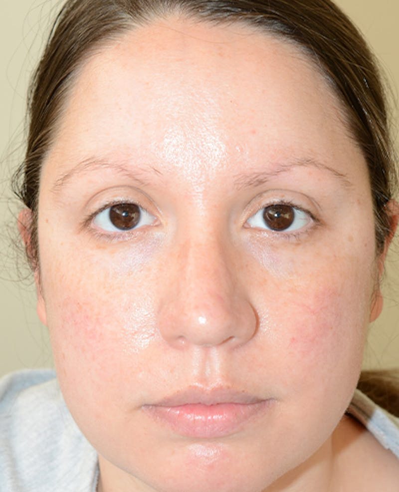 Eyebrow Transplantation Before & After Gallery - Patient 305873 - Image 1