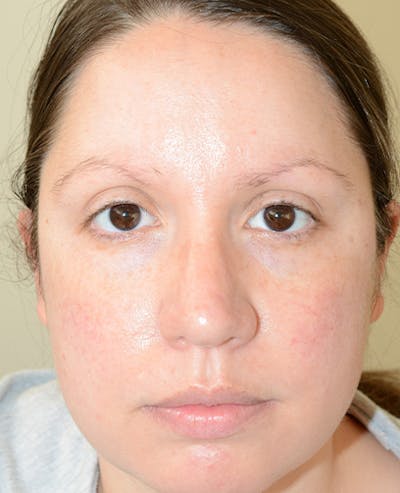 Eyebrow Transplantation Before & After Gallery - Patient 358826 - Image 1