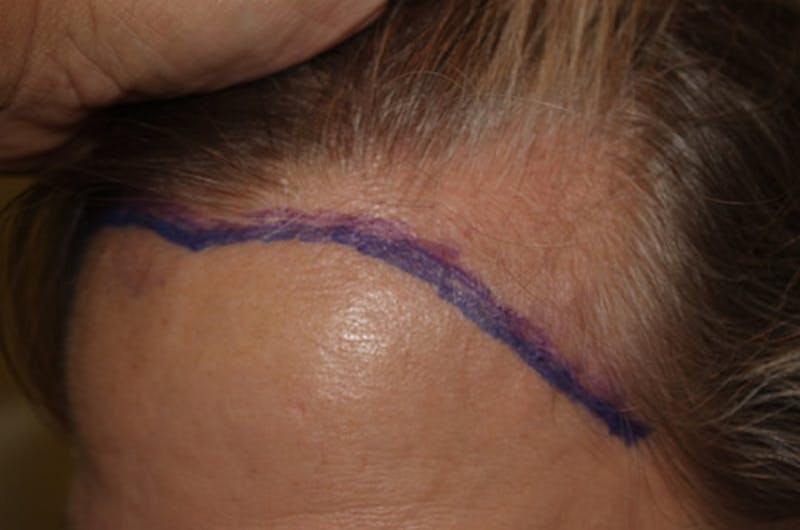 Hair Procedures for Women Before & After Gallery - Patient 322709 - Image 1
