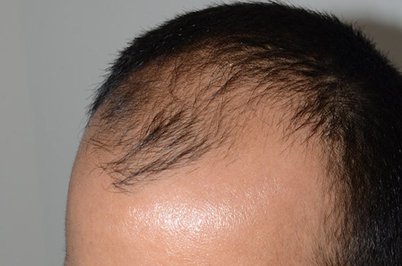 Hair Restoration for Men Before & After Gallery - Patient 223738 - Image 5