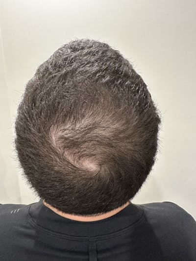 SMP Procedures Before & After Gallery - Patient 363528 - Image 1