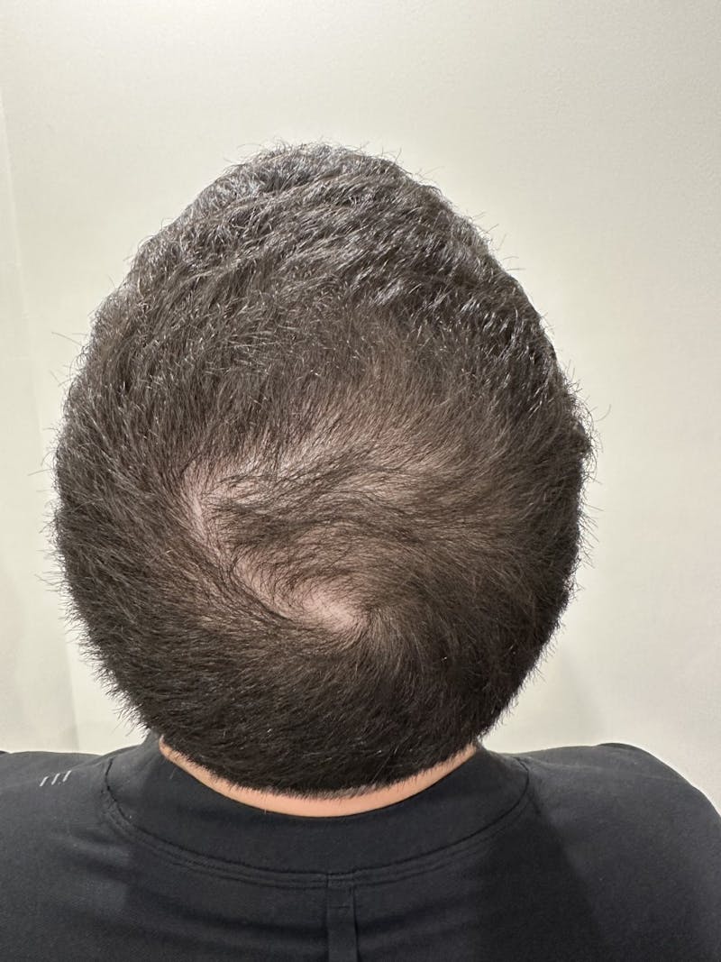 Scalp Micropigmentation Procedures Before & After Gallery - Patient 216793 - Image 1