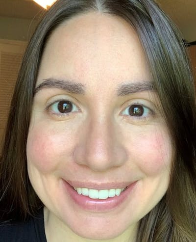 Eyebrow Transplantation Before & After Gallery - Patient 358826 - Image 2