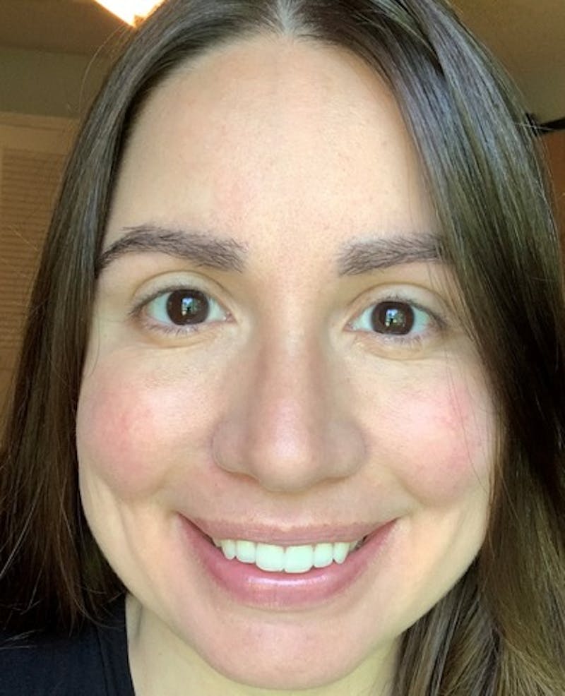 Eyebrow Transplantation Before & After Gallery - Patient 305873 - Image 2