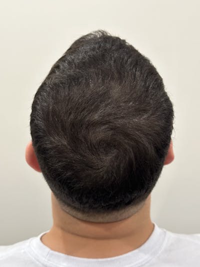 SMP Procedures Before & After Gallery - Patient 363528 - Image 2