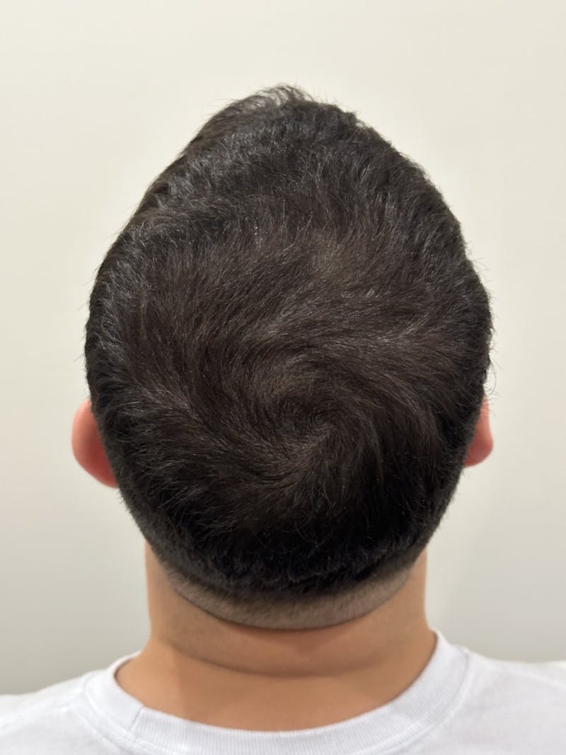 Scalp Micropigmentation Procedures Before & After Gallery - Patient 216793 - Image 2