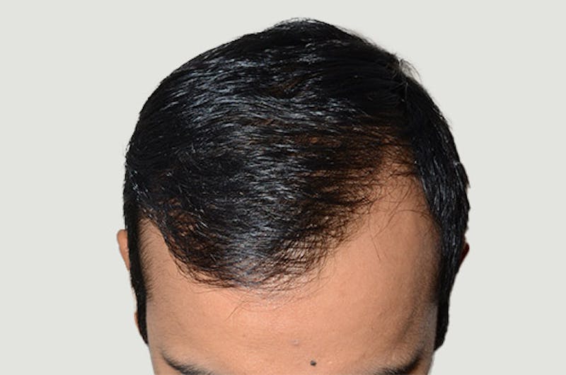 Hair Restoration for Men Before & After Gallery - Patient 223738 - Image 6
