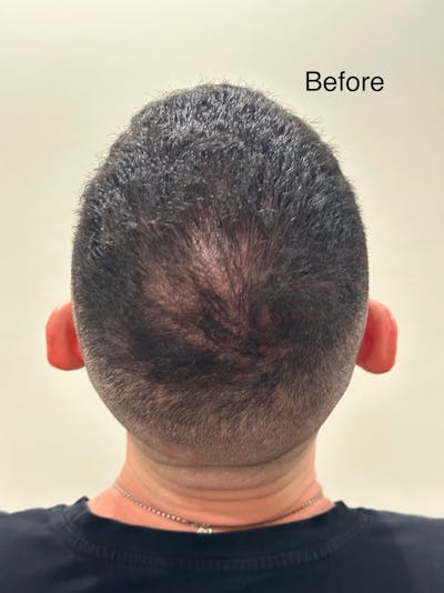 SMP Procedures Before & After Gallery - Patient 186110 - Image 1