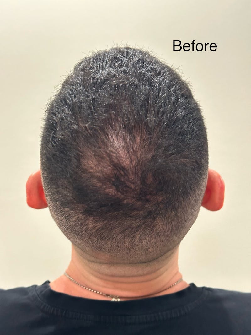Scalp Micropigmentation Procedures Before & After Gallery - Patient 929931 - Image 1