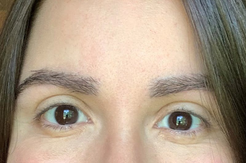 Eyebrow Transplantation Before & After Gallery - Patient 305873 - Image 4