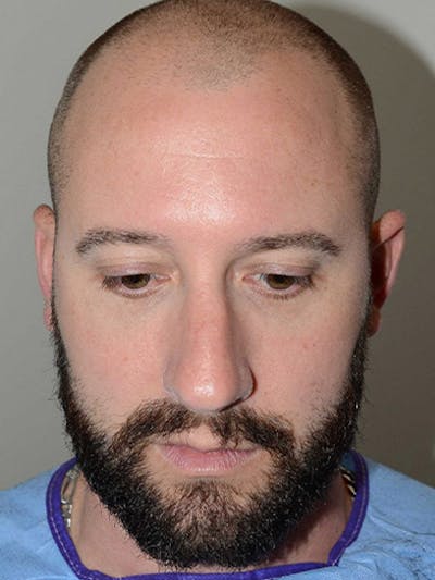 Hair Restoration for Men Before & After Gallery - Patient 651133 - Image 1