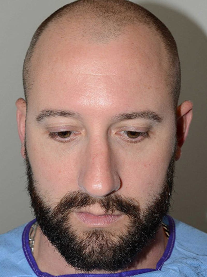 Hair Restoration for Men Before & After Gallery - Patient 136473 - Image 1