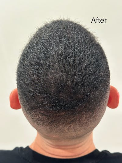 SMP Procedures Before & After Gallery - Patient 186110 - Image 2