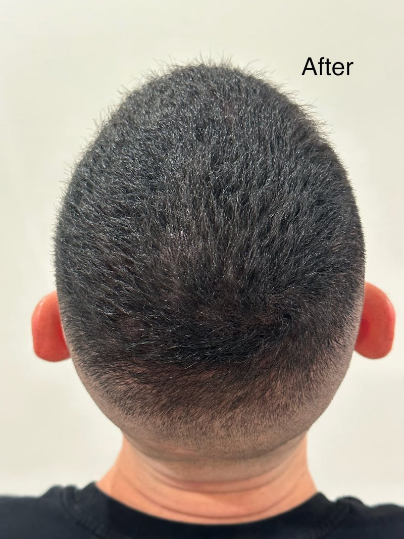 Scalp Micropigmentation Procedures Before & After Gallery - Patient 929931 - Image 2