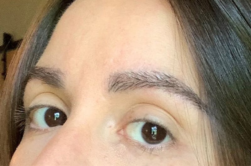 Eyebrow Transplantation Before & After Gallery - Patient 305873 - Image 6