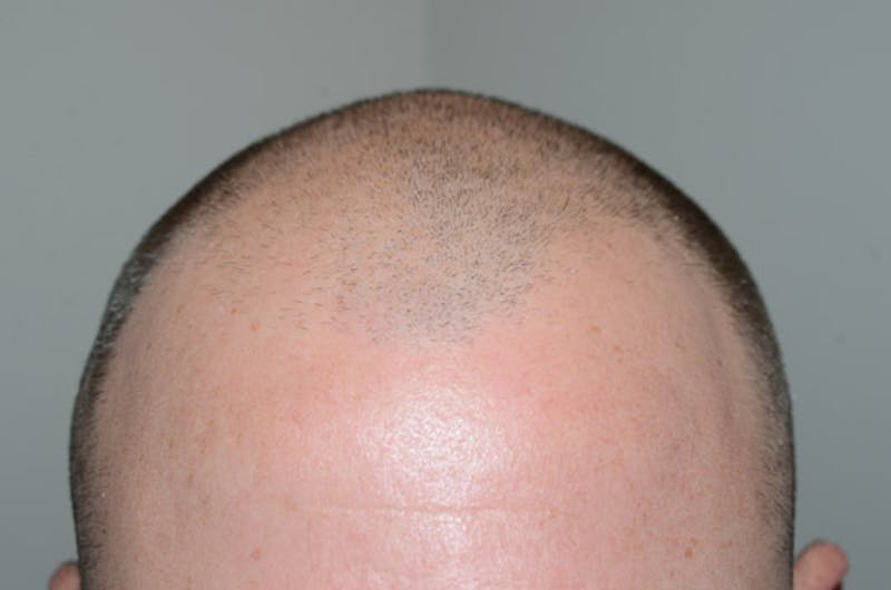 Hair Restoration for Men Before & After Gallery - Patient 136473 - Image 3