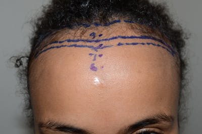 Hairline Lowering Surgery Before & After Gallery - Patient 150259 - Image 1