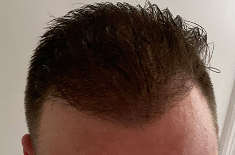 Hair Restoration for Men Before & After Gallery - Patient 136473 - Image 4
