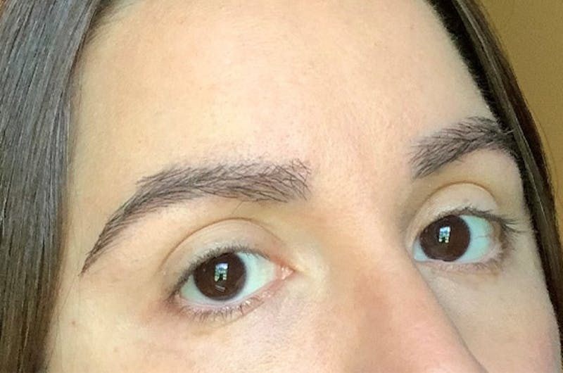 Eyebrow Transplantation Before & After Gallery - Patient 305873 - Image 8