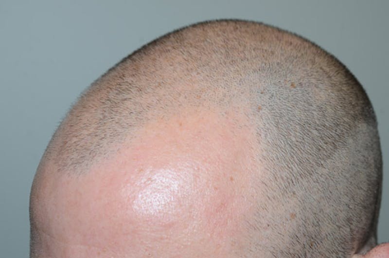Hair Restoration for Men Before & After Gallery - Patient 136473 - Image 5