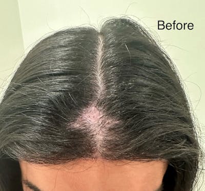 SMP Procedures Before & After Gallery - Patient 274433 - Image 1