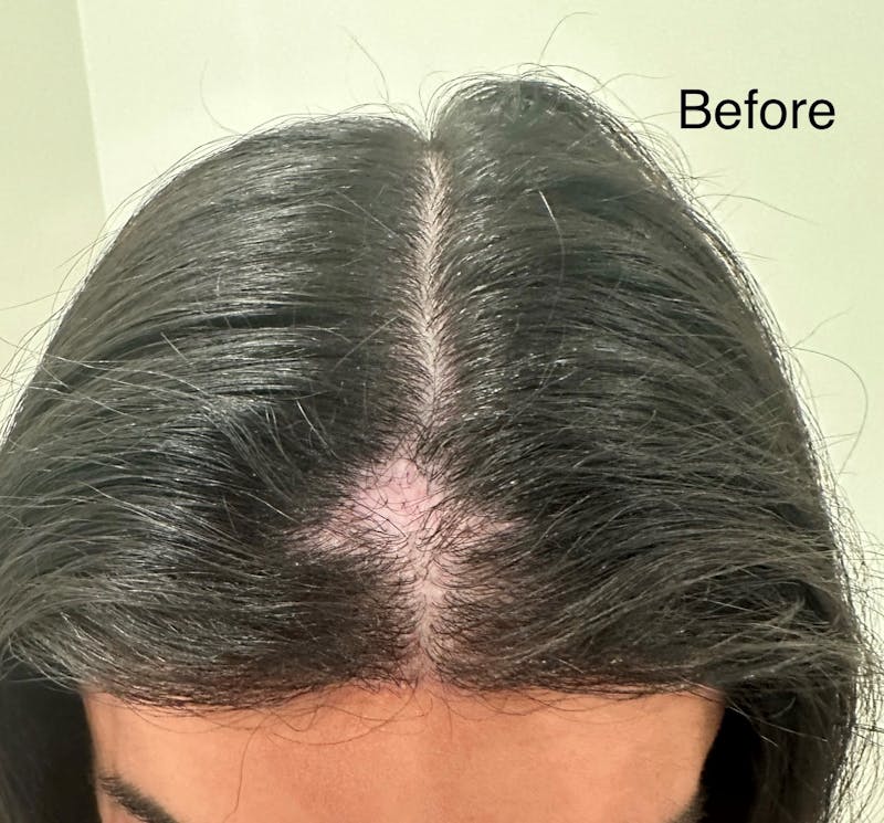 Scalp Micropigmentation Procedures Before & After Gallery - Patient 168752 - Image 1