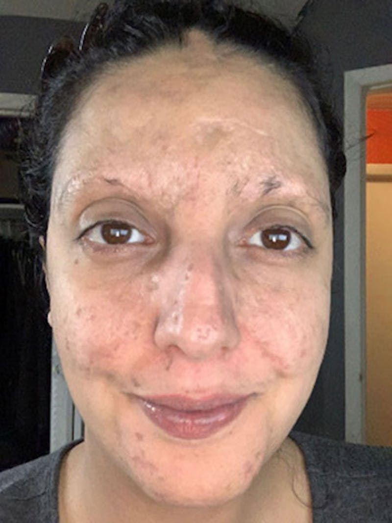 Eyebrow Transplantation Before & After Gallery - Patient 889211 - Image 1