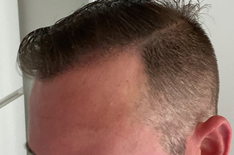 Hair Restoration for Men Before & After Gallery - Patient 136473 - Image 6