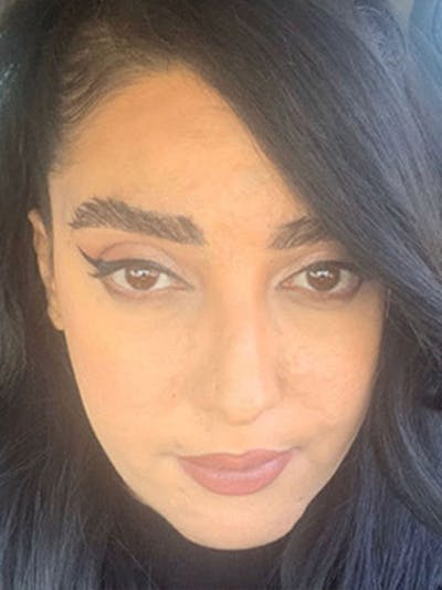 Eyebrow Transplantation Before & After Gallery - Patient 182094 - Image 2