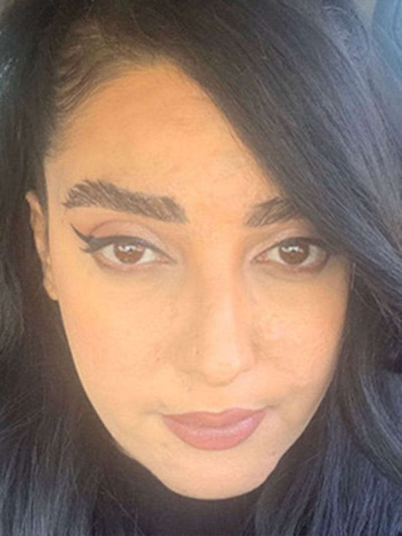 Eyebrow Transplantation Before & After Gallery - Patient 889211 - Image 2