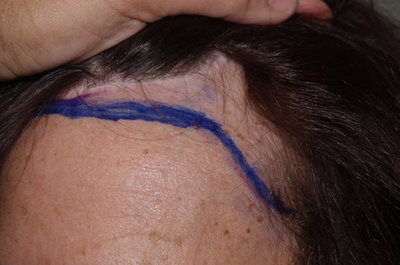 Hair Procedures for Women Before & After Gallery - Patient 111009 - Image 1