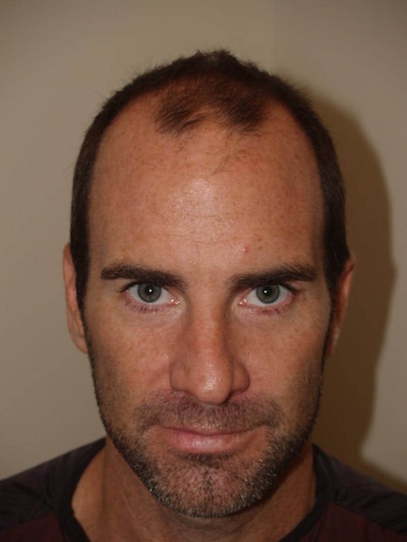 Hair Restoration for Men Before & After Gallery - Patient 230810 - Image 1