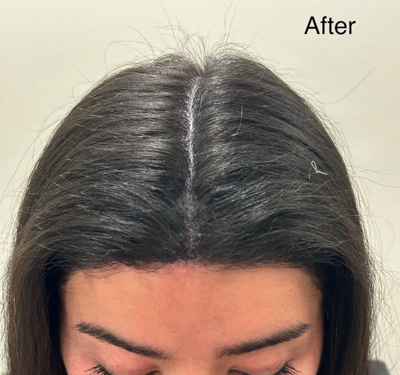 Scalp Micropigmentation Procedures Before & After Gallery - Patient 168752 - Image 2