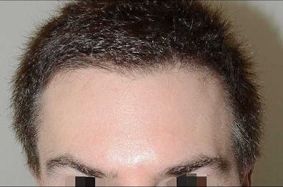 Eyebrow Transplantation Before & After Gallery - Patient 245934 - Image 1